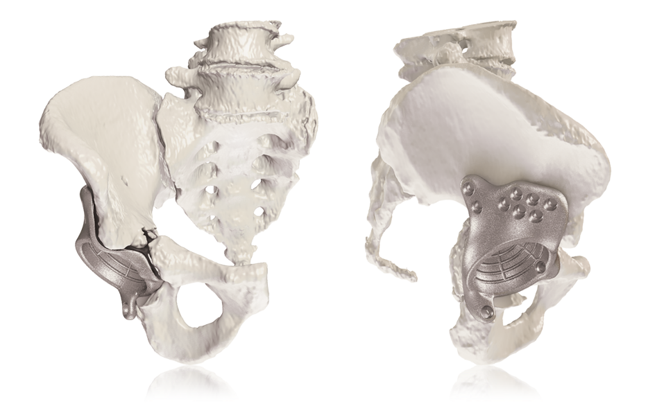 My3D® Personalized Pelvic Reconstruction